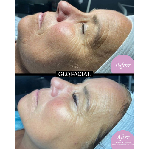 Glo2Facial + RF & 10 Units of Tox