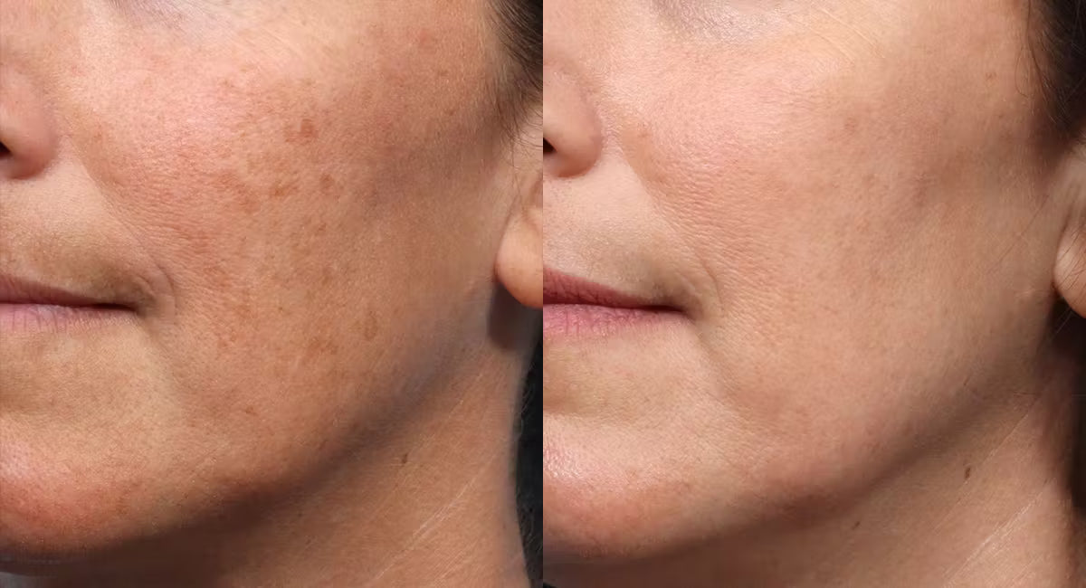 EZGel + Ultra Skin Resurfacing