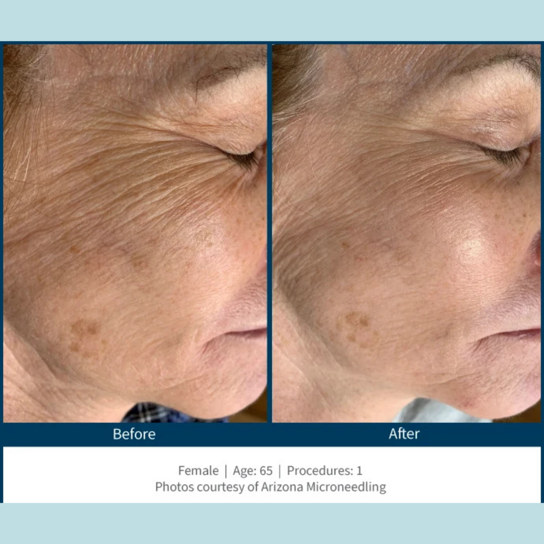SkinPen Microneedling
