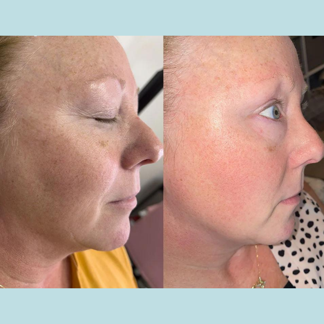 SkinPen Microneedling