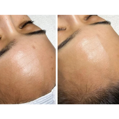 Glo2Facial + RF & 10 Units of Tox