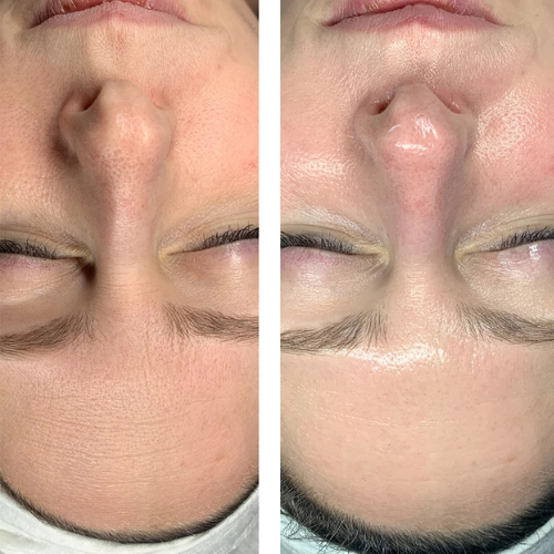 Glo2Facial + RF & 10 Units of Tox