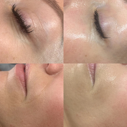 Glo2Facial + RF & 10 Units of Tox