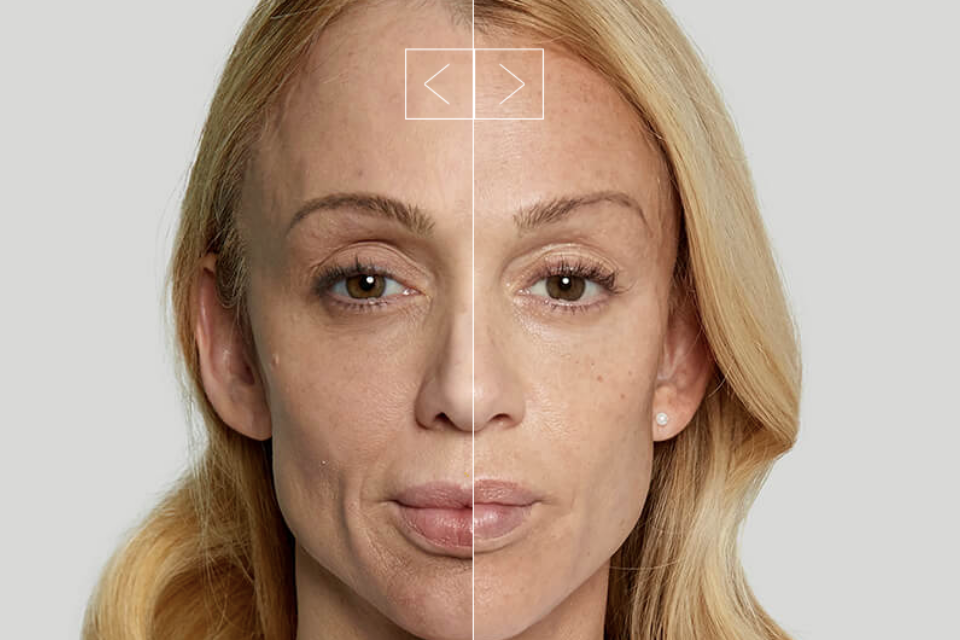 Sculptra + Ultra Skin Resurfacing
