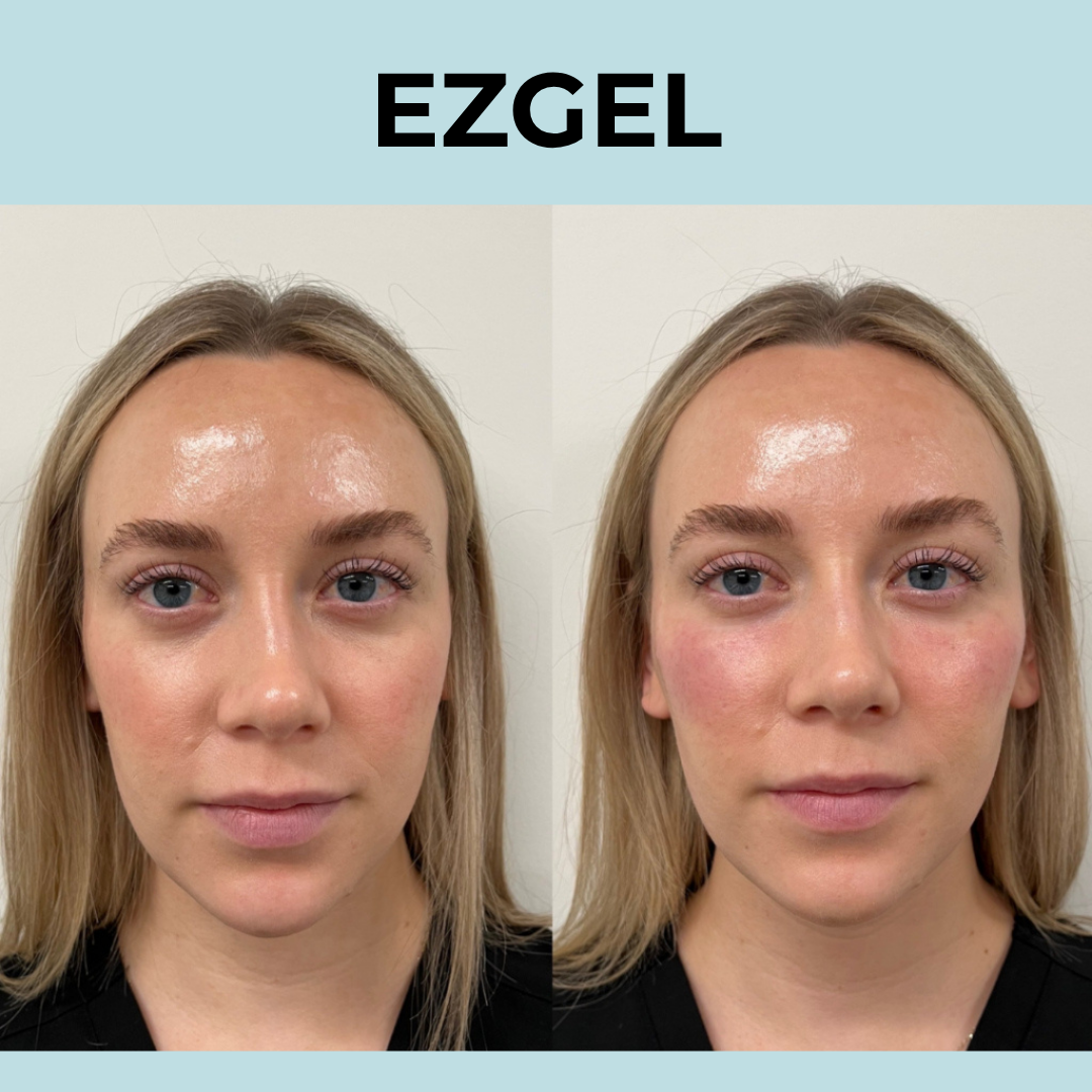 EZGel + Ultra Skin Resurfacing