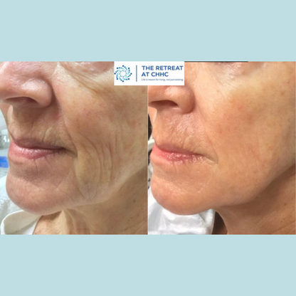 SkinPen Microneedling