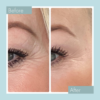 SkinPen Microneedling