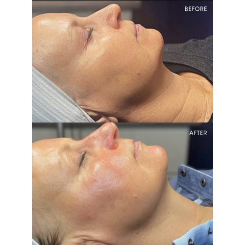 Glo2Facial + RF & 10 Units of Tox